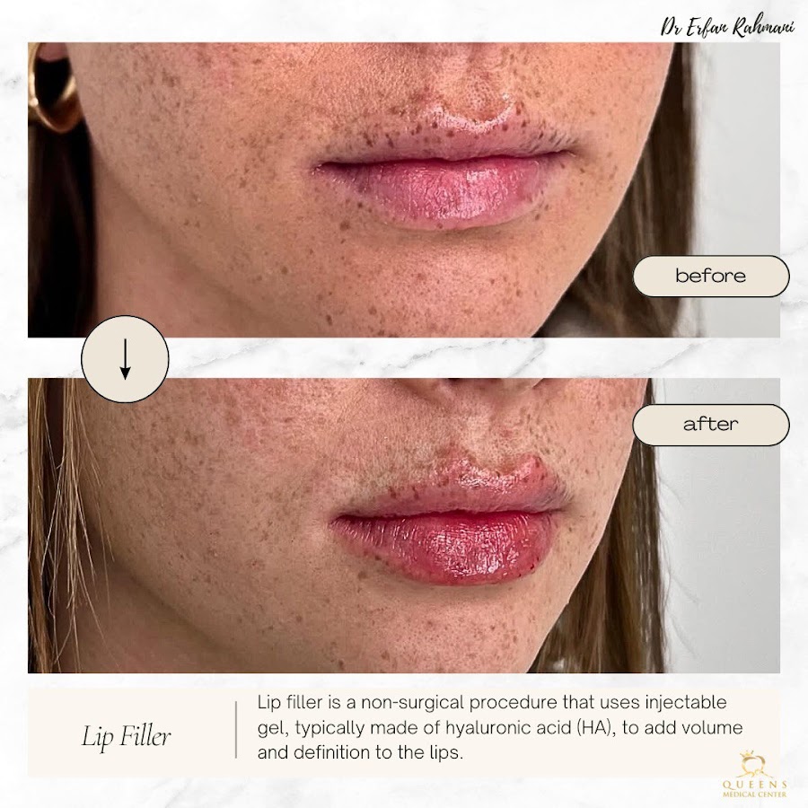 Dr. Erfan Rahmani| advanced Endolift Laser | Morpheus | Face contouring | Filler — photo 4